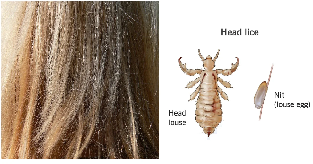 Head lice: Natural Remedies for Lice